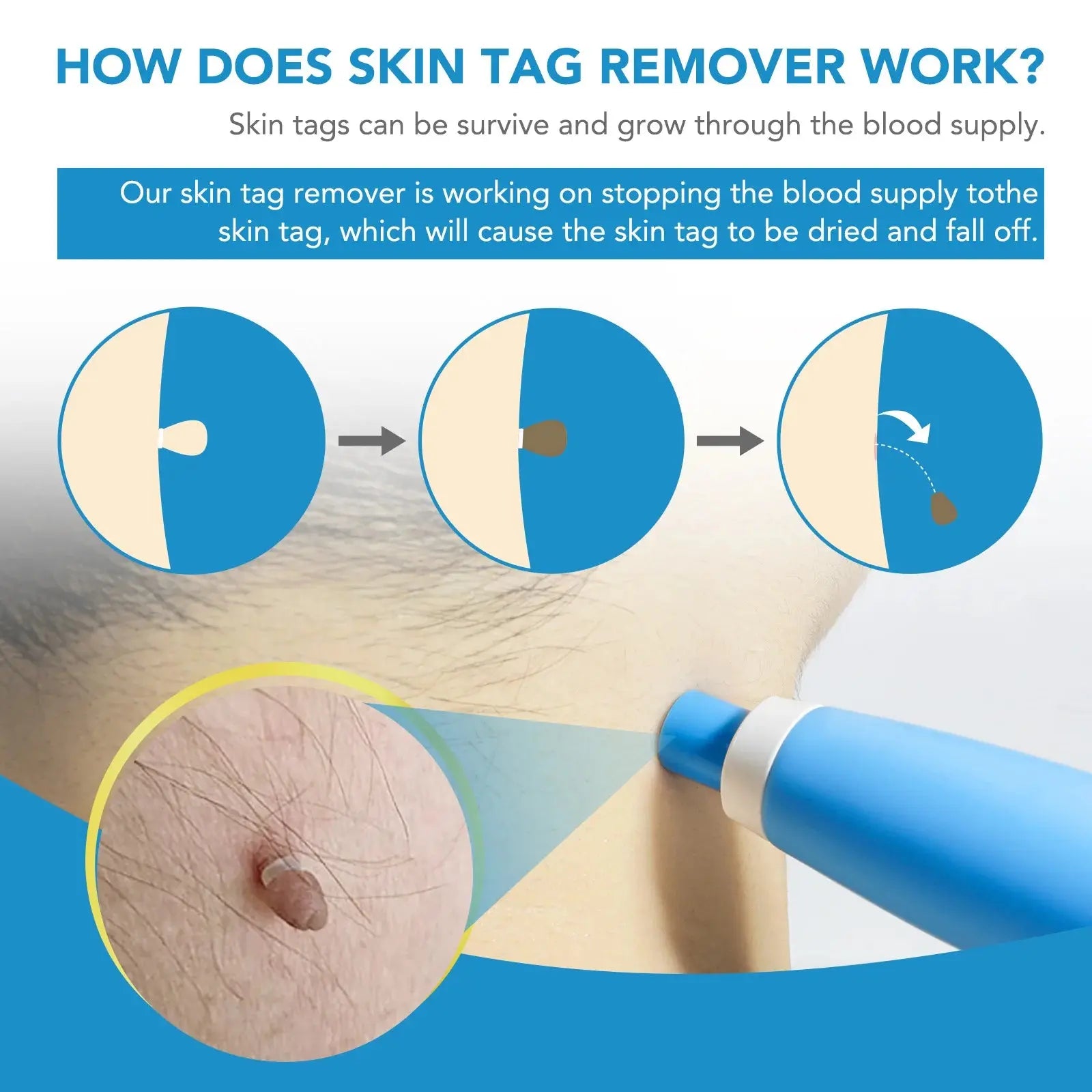 SkinPro™ Auto Skin Tag & Wart Removal Kit Shopulia